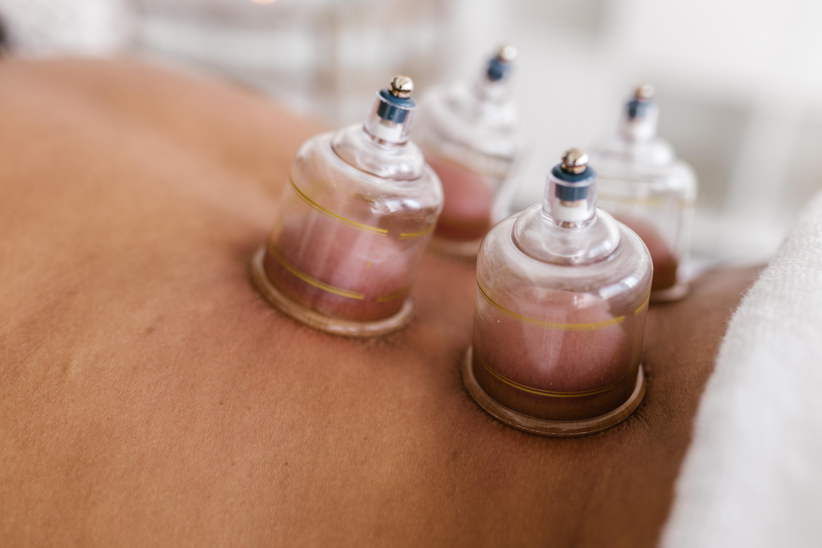 A Placebo Or Performance Enhancer: Cupping Therapy